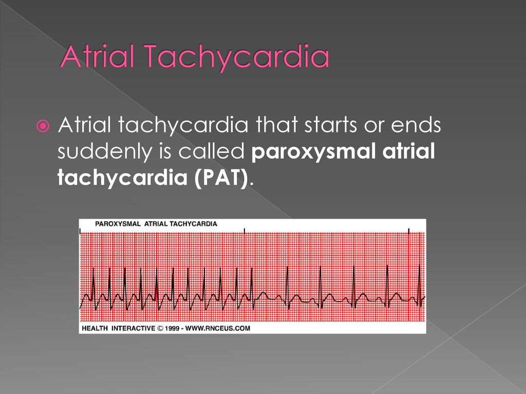 Chapter 4 Atrial Rhythms Ppt Download
