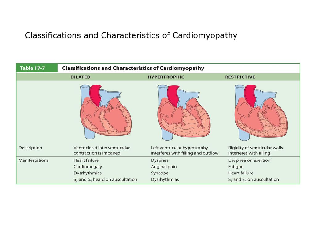 Classifications and Characteristics of Cardiomyopathy