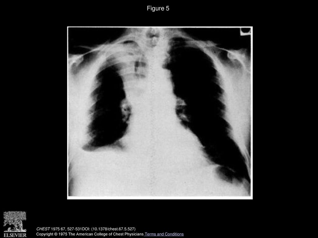 Figure 5 Case no. 2—PA chest roentgenogram demonstrating right pleural effusion, right upper lobe infiltrate.