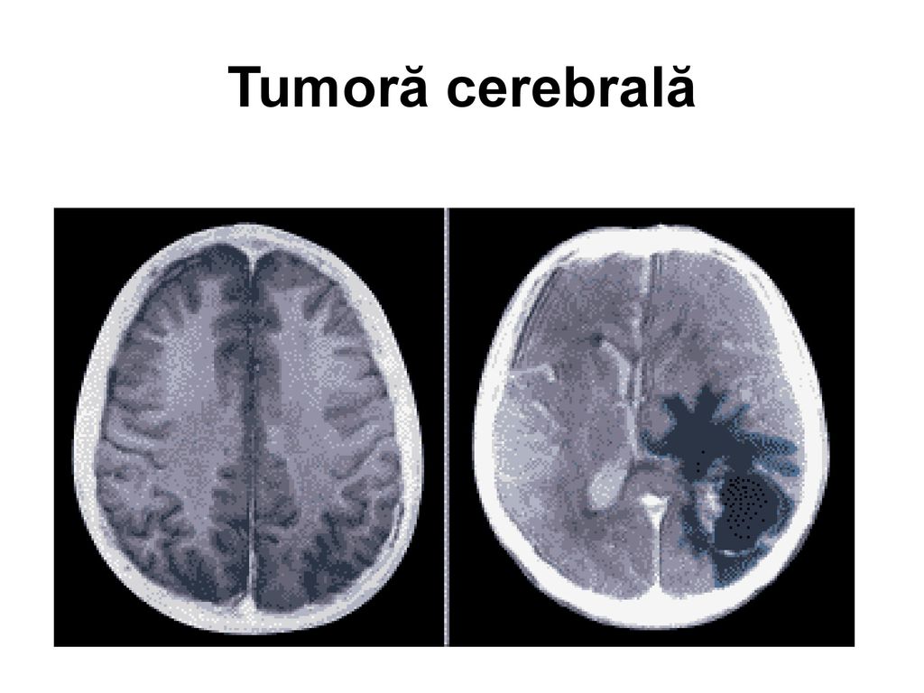 prostatita tumorală cerebrală