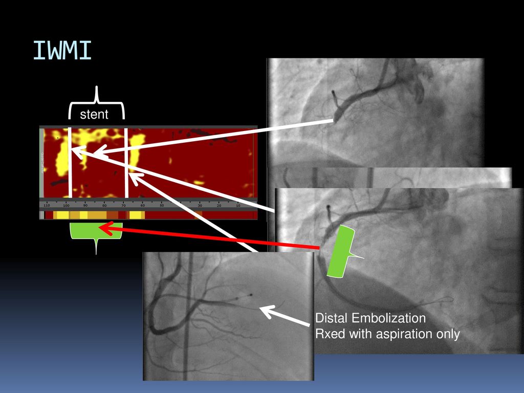IWMI stent Distal Embolization Rxed with aspiration only