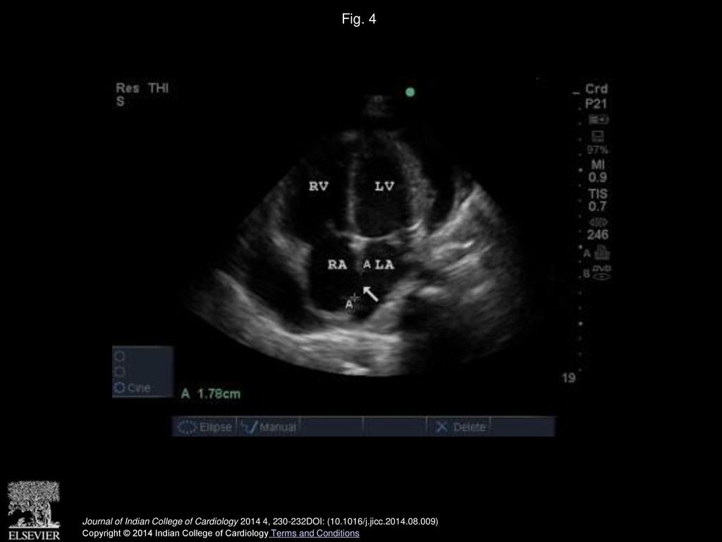 Fig. 4 Transthoracic echocardiography (4 chamber view) showing a large secundum atrial septal defect.