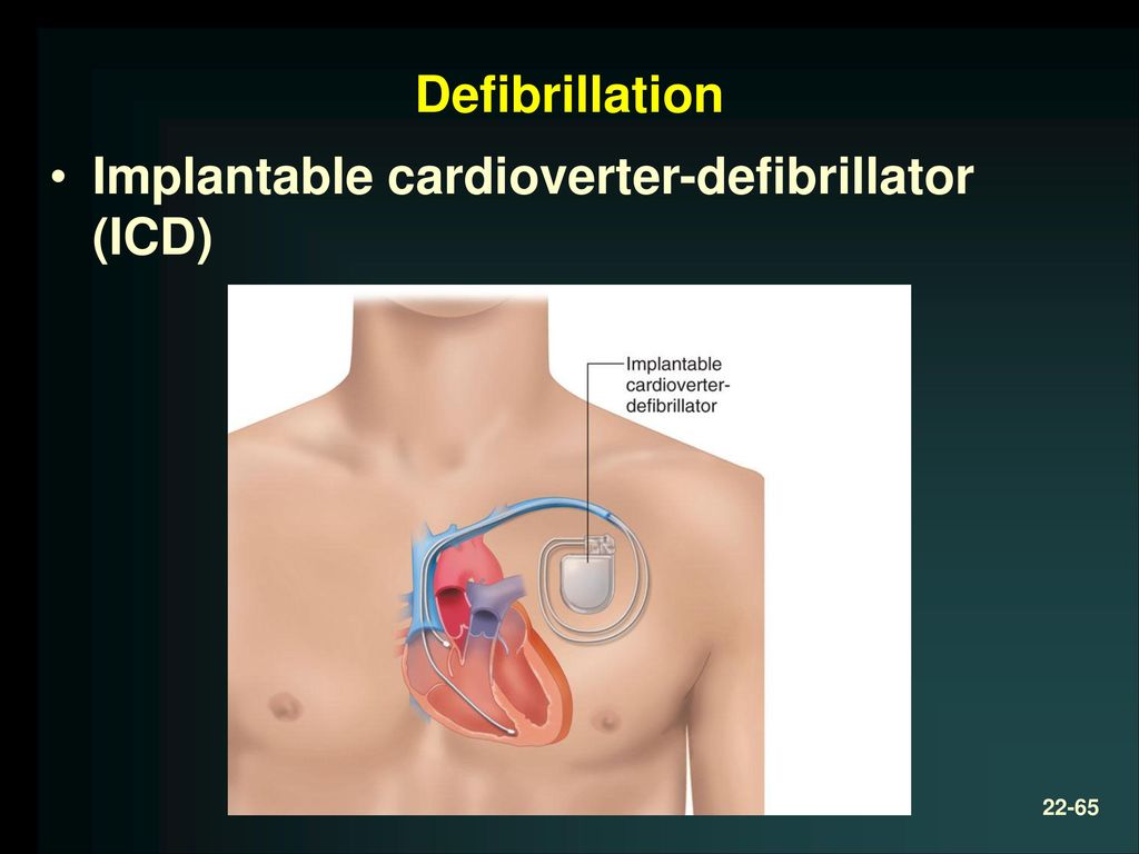 Chapter 22 Cardiovascular Emergencies - ppt download