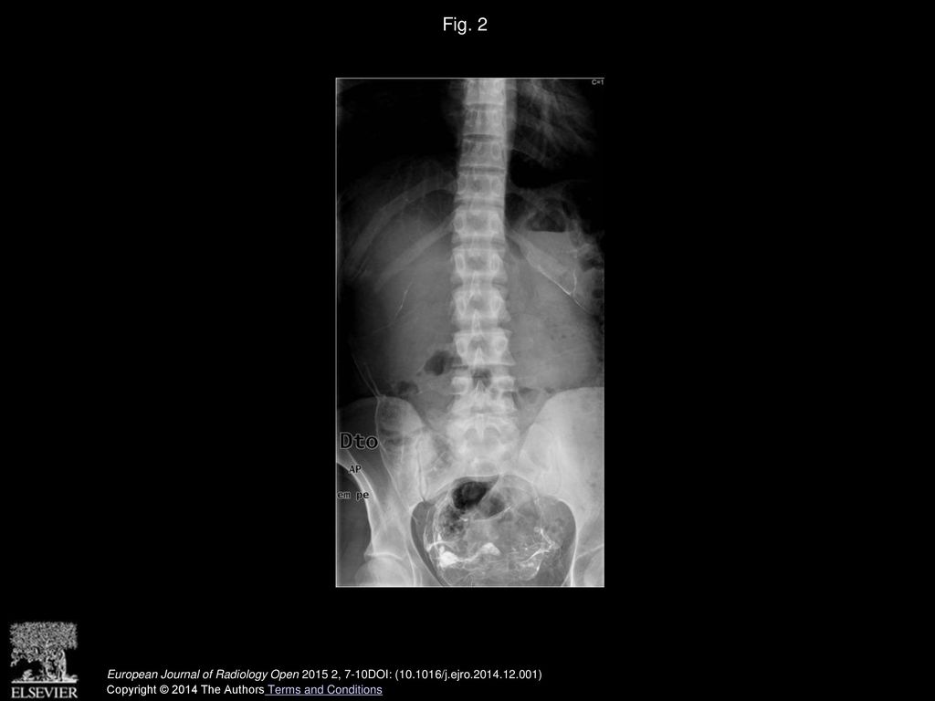 Fig. 2 A lumbar radiography showed diffuse peritoneal calcification, most evident in the lower abdomen.