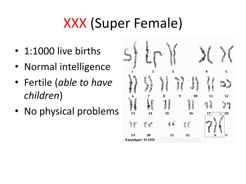 XXX (Super Female) 1:1000 live births Normal intelligence