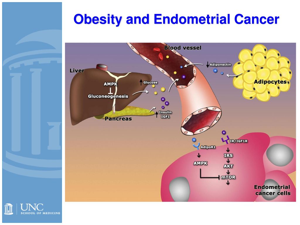Endometrial cancer and obesity., Endometrial cancer and obesity