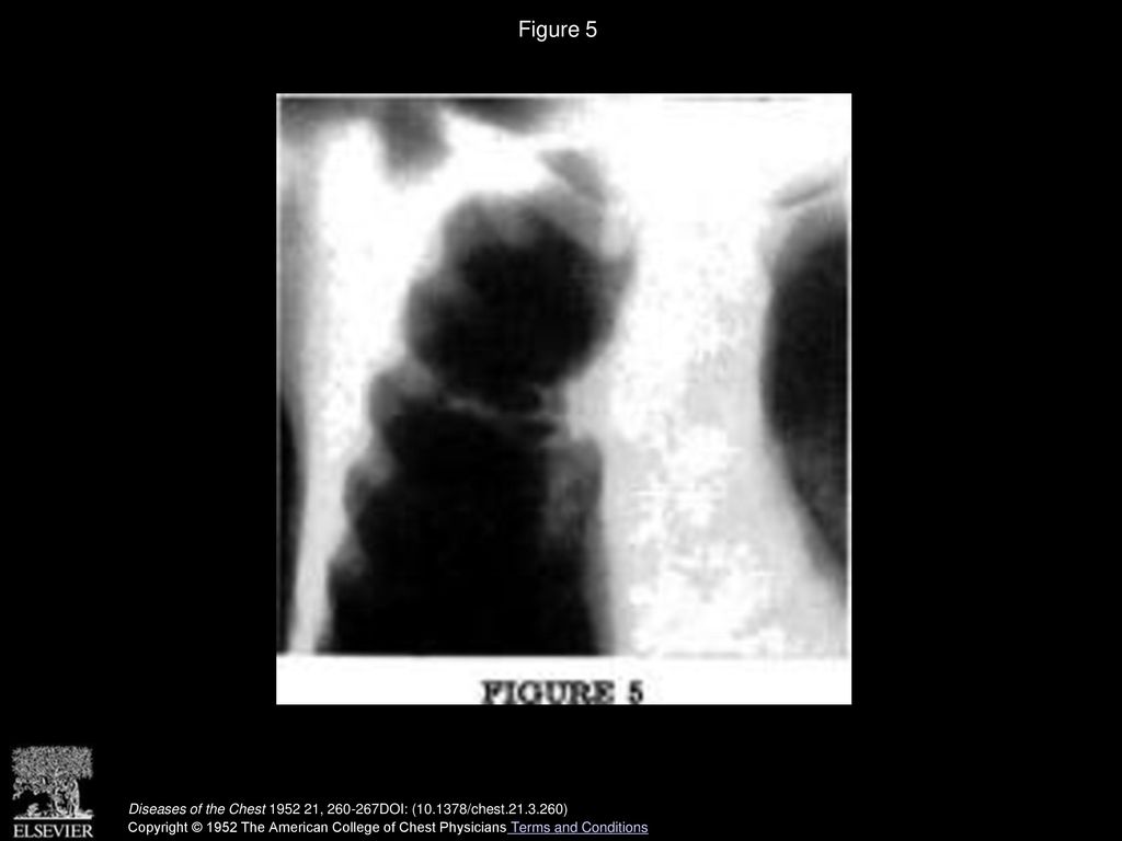 Figure 5 Laminagram showing bronchiectasis of pectoral segment, with large, partly calcified hilar node pressing on bronchus.