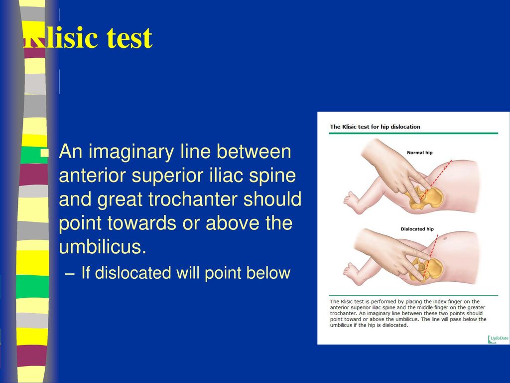 Klisic test An imaginary line between anterior superior iliac spine and great trochanter should point towards or above the umbilicus.