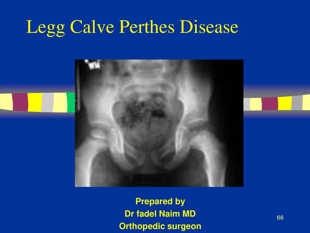 Legg Calve Perthes Disease