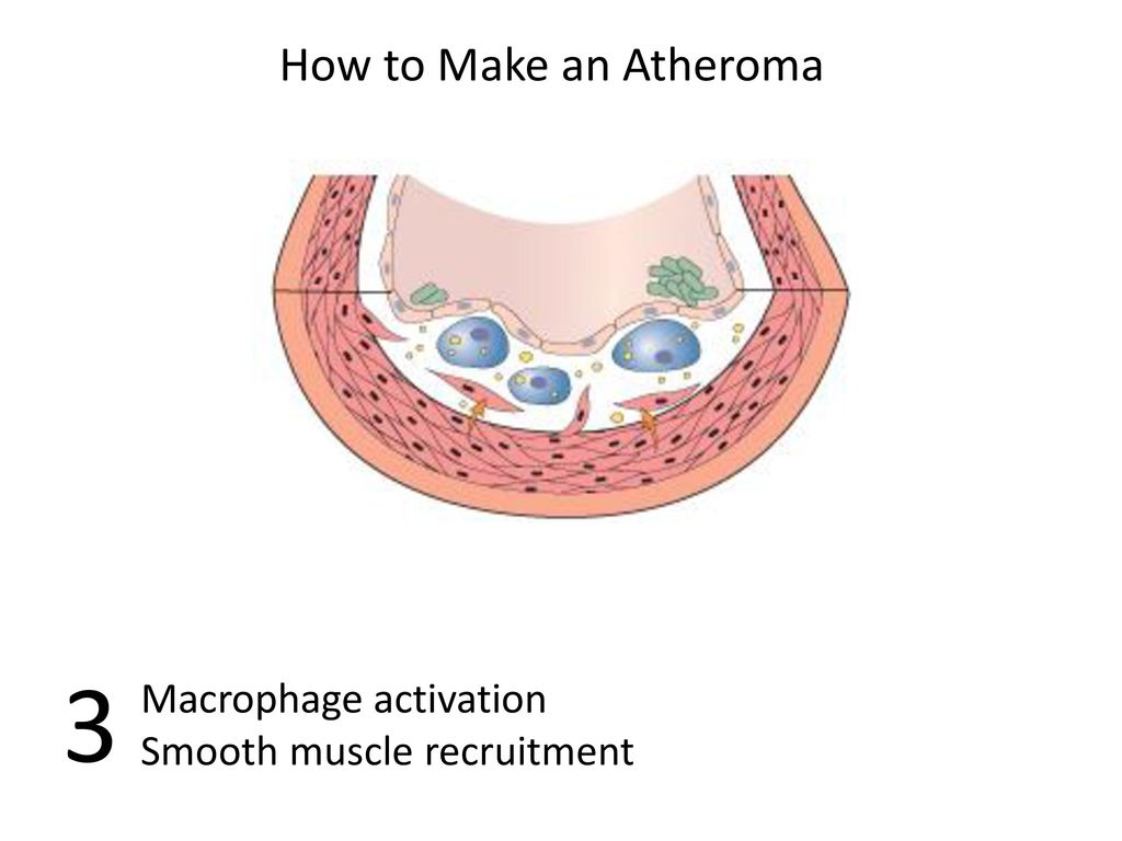 3 How to Make an Atheroma Macrophage activation