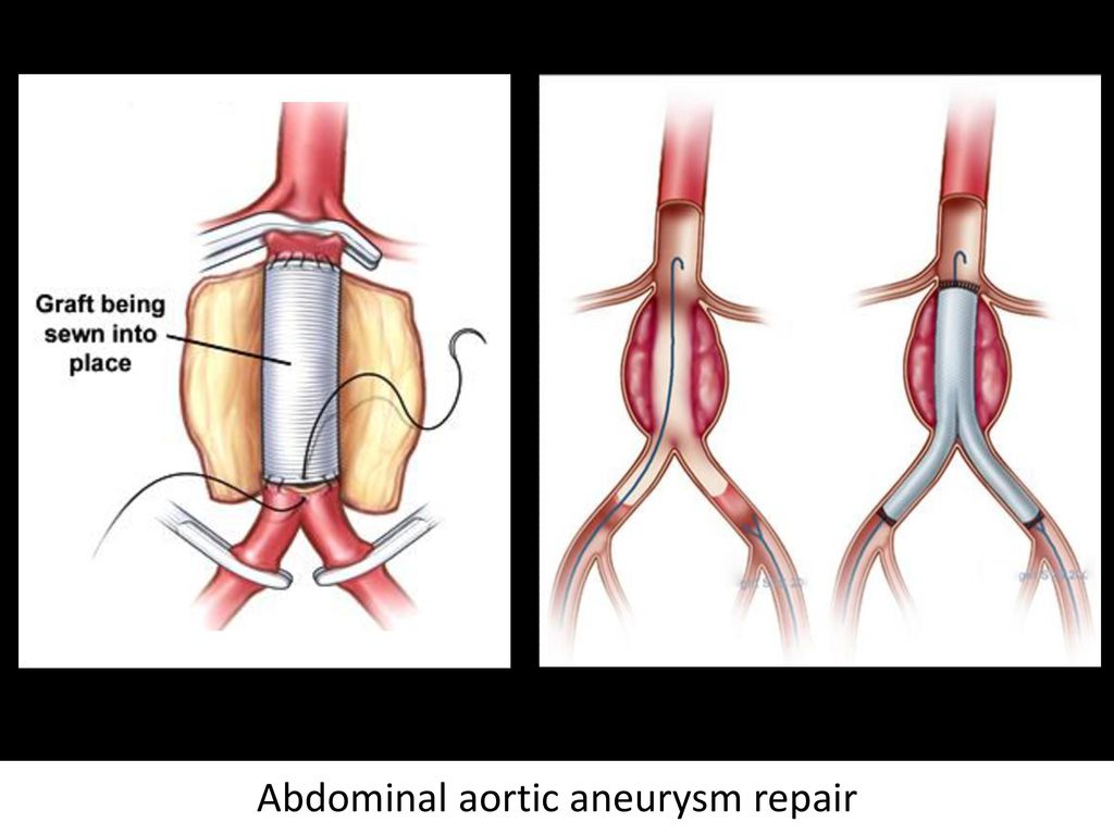 Abdominal aortic aneurysm repair