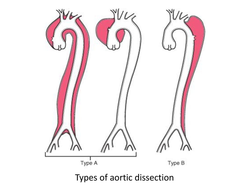 Types of aortic dissection