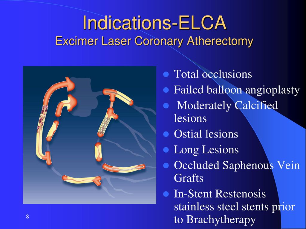 The use of Laser for the treatment of coronary artery disease - ppt download