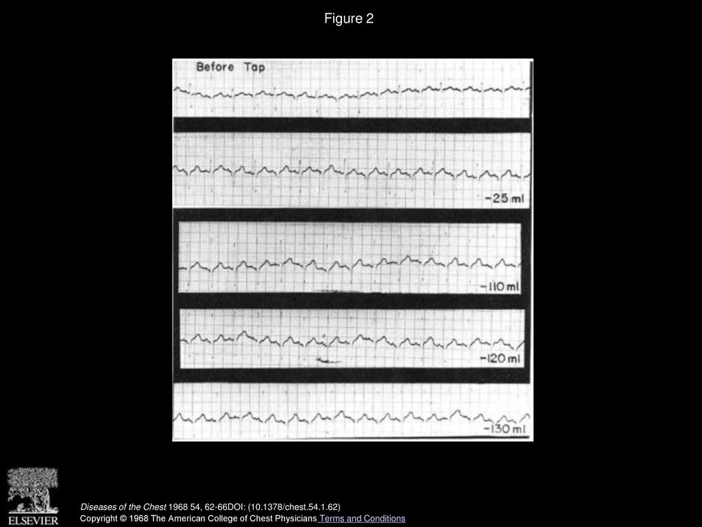 Subacute Constrictive Pericarditis with Cardiac Tamponade - ppt download