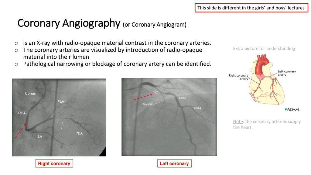 Coronary Angiography (or Coronary Angiogram)