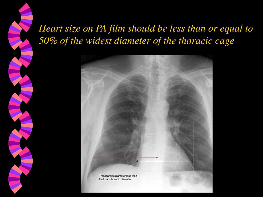 Heart size on PA film should be less than or equal to 50% of the widest diameter of the thoracic cage