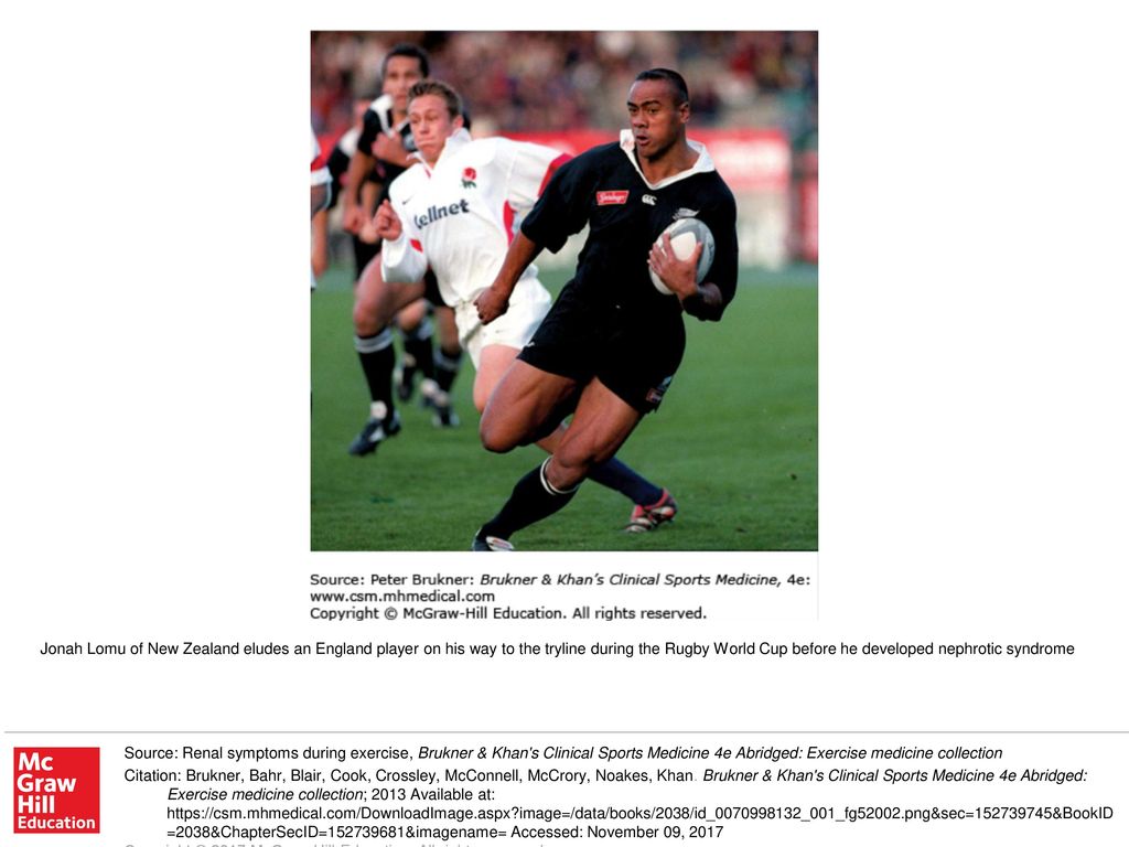 Jonah Lomu Of New Zealand Eludes An England Player On His Way To The Tryline During The Rugby World Cup Before He Developed Nephrotic Syndrome Source Ppt Download