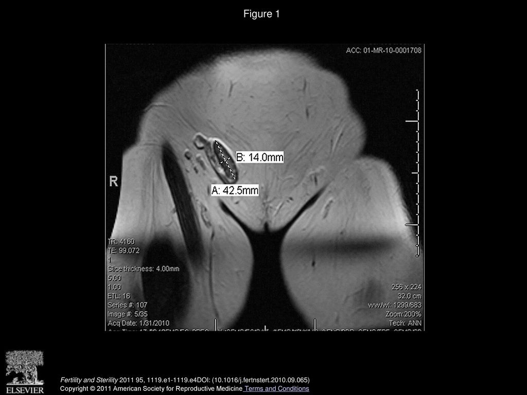 Figure 1 Magnetic resonance imaging: right ovary in the right inguinal canal.