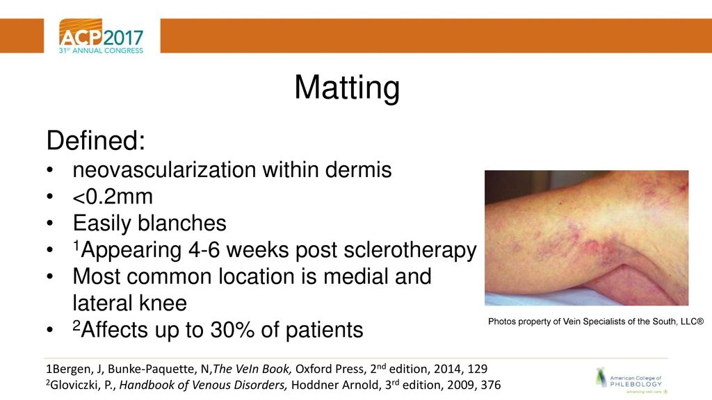 Avoiding Sclerotherapy Complications Decreasing Risks of - ppt download