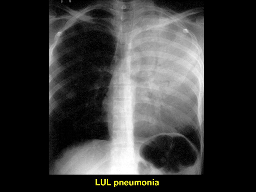 Пневмония верхней доли легкого. Крупозная пневмония рентгенограмма. Крупозная пневмония рентген снимок. Крупозная пневмония стадия прилива рентген. Крупозная пневмония рентген признаки.