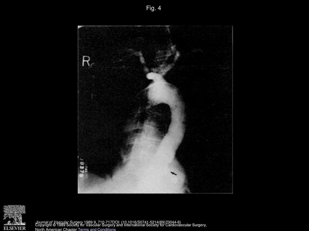 Fig. 4 Thoracic aortogram of patient 2 shows an aneurysm of the descending thoracic aorta with a focal atheromatous ulcer (arrow).