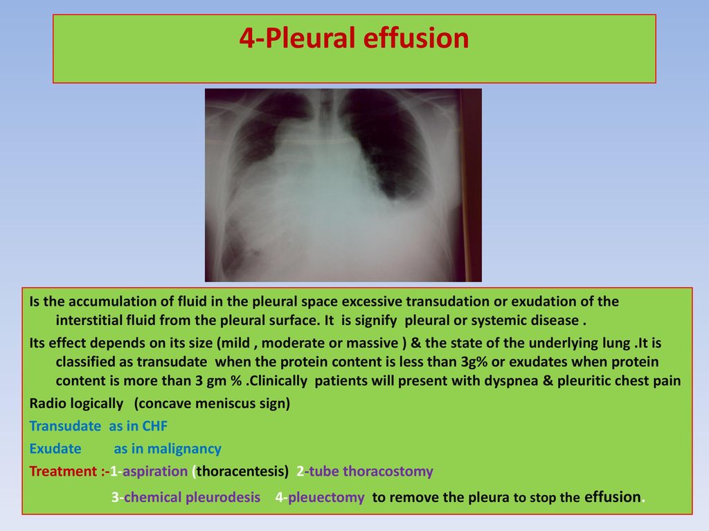 4-Pleural effusion