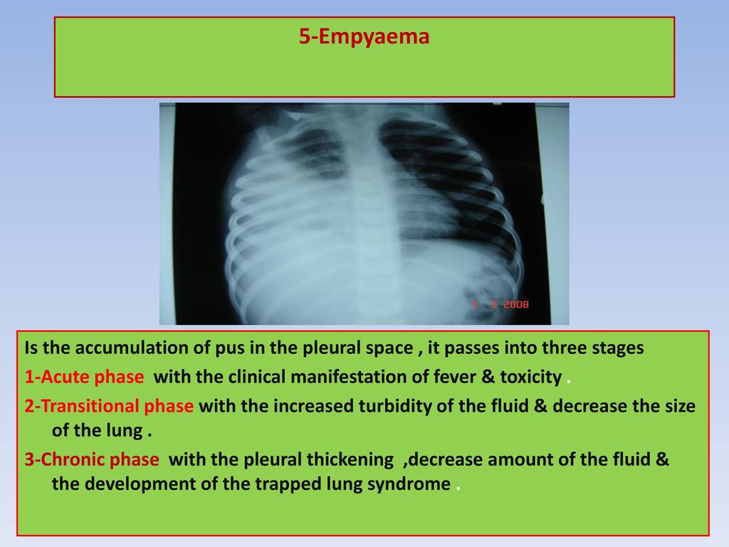 5-Empyaema Is the accumulation of pus in the pleural space , it passes into three stages.