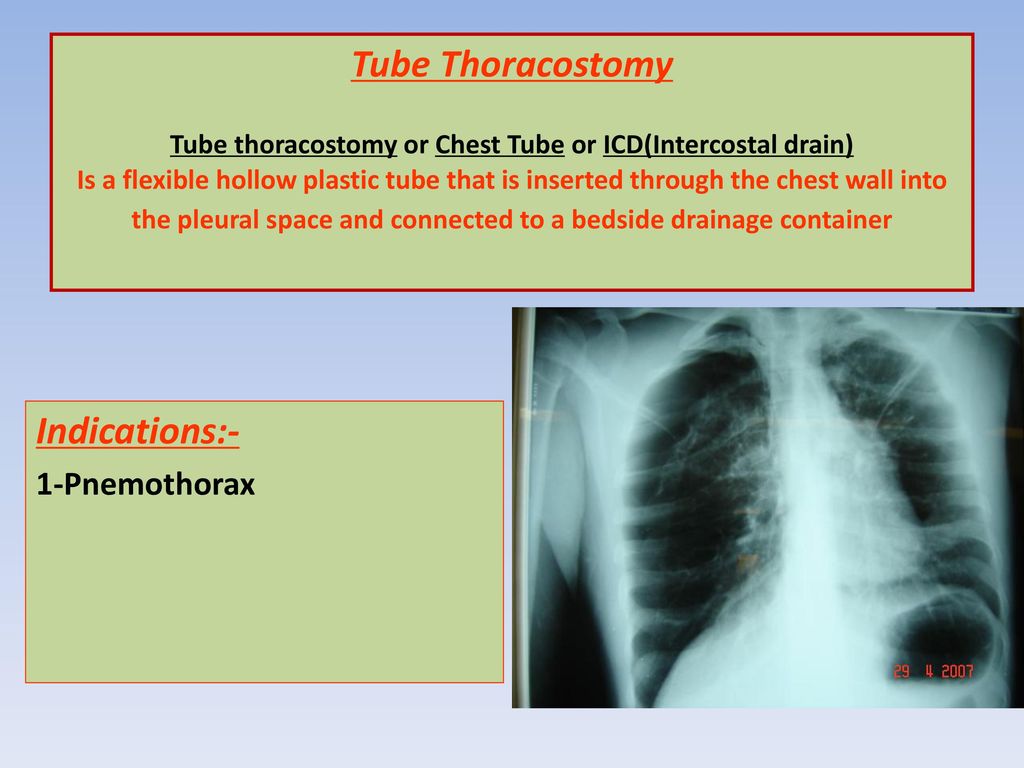 Tube Thoracostomy Tube thoracostomy or Chest Tube or ICD(Intercostal drain) Is a flexible hollow plastic tube that is inserted through the chest wall into the pleural space and connected to a bedside drainage container