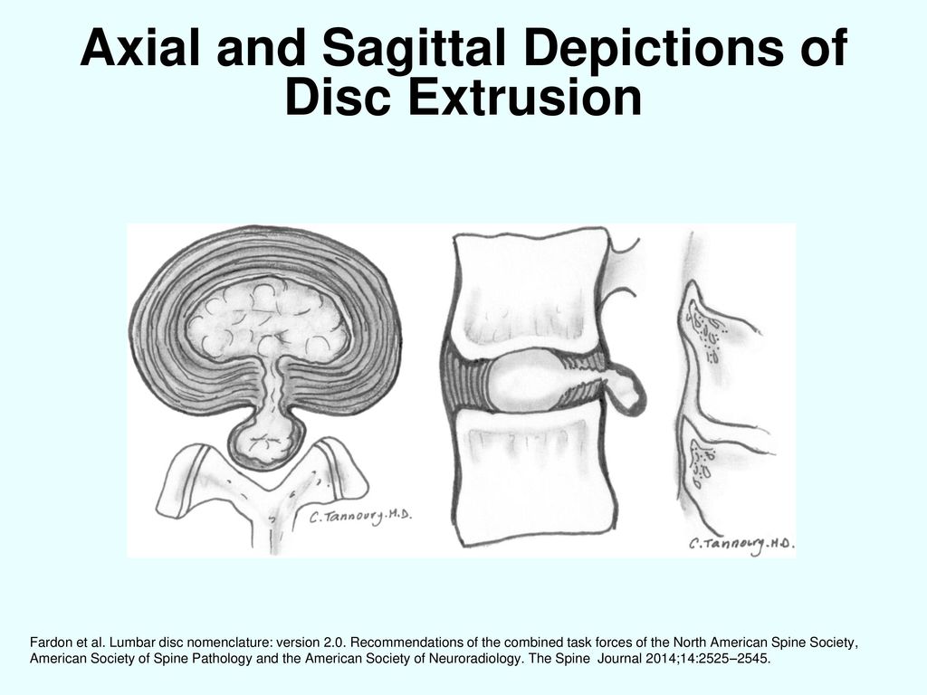 Axial and Sagittal Depictions of Disc Extrusion