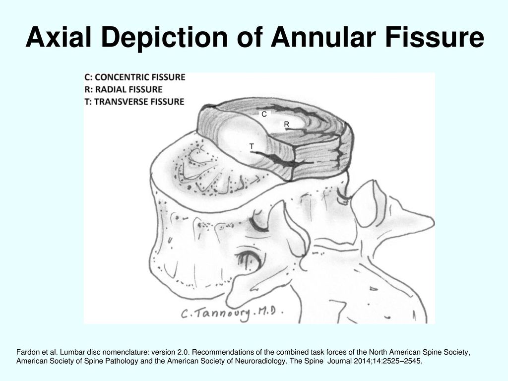 Axial Depiction of Annular Fissure