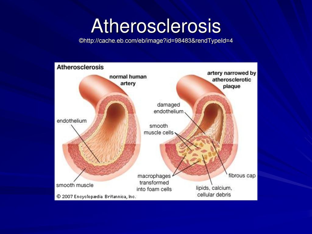 Atherosclerosis. - ppt download