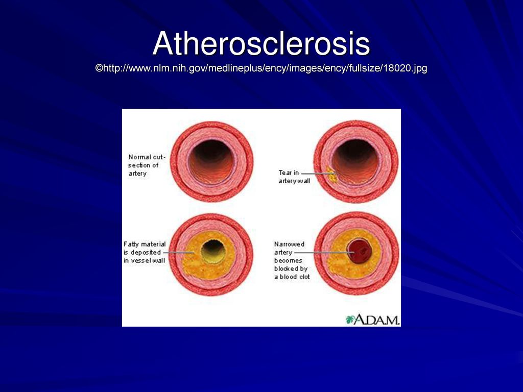 Atherosclerosis. - ppt download