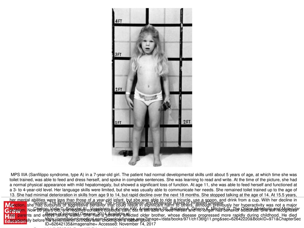 MPS IIIA (Sanfilippo syndrome, type A) in a 7-year-old girl