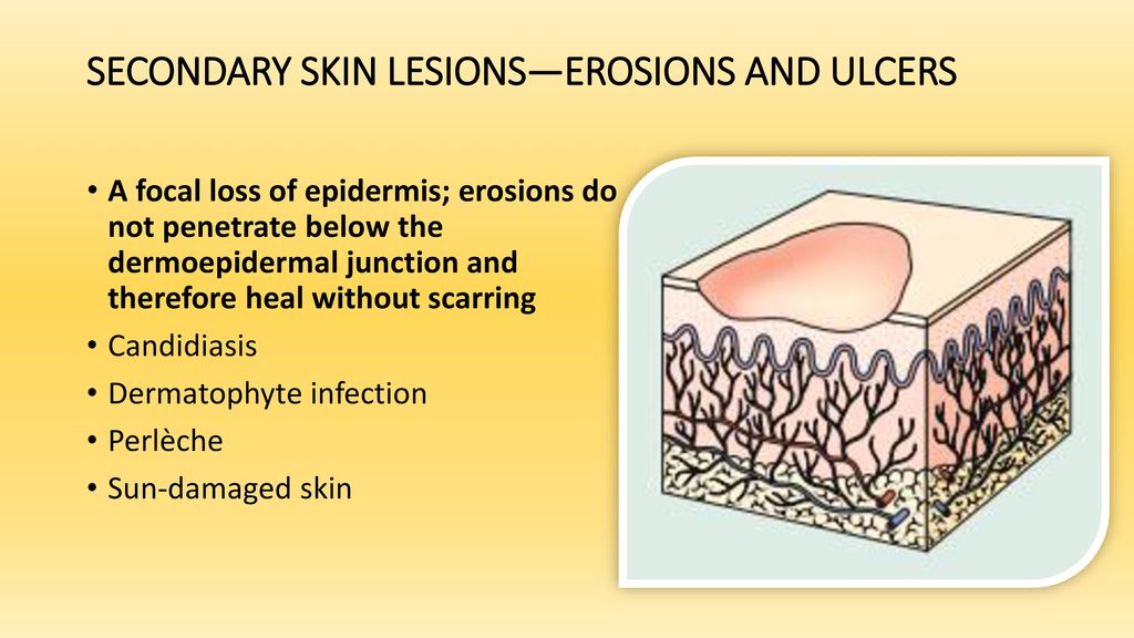 SECONDARY SKIN LESIONS—EROSIONS AND ULCERS