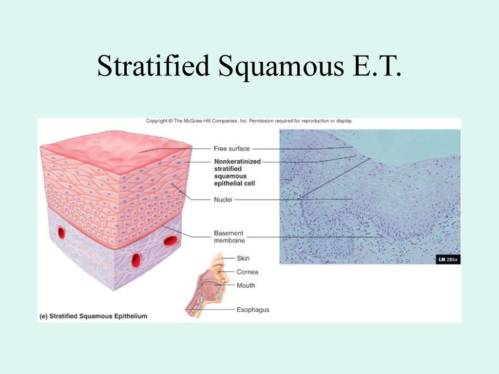 Stratified Squamous E.T.