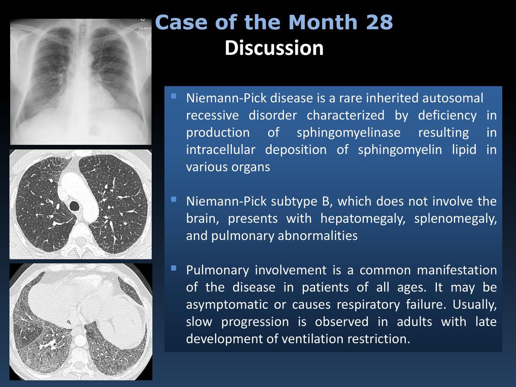 Niemann-Pick disease type B: HRCT assessment of pulmonary