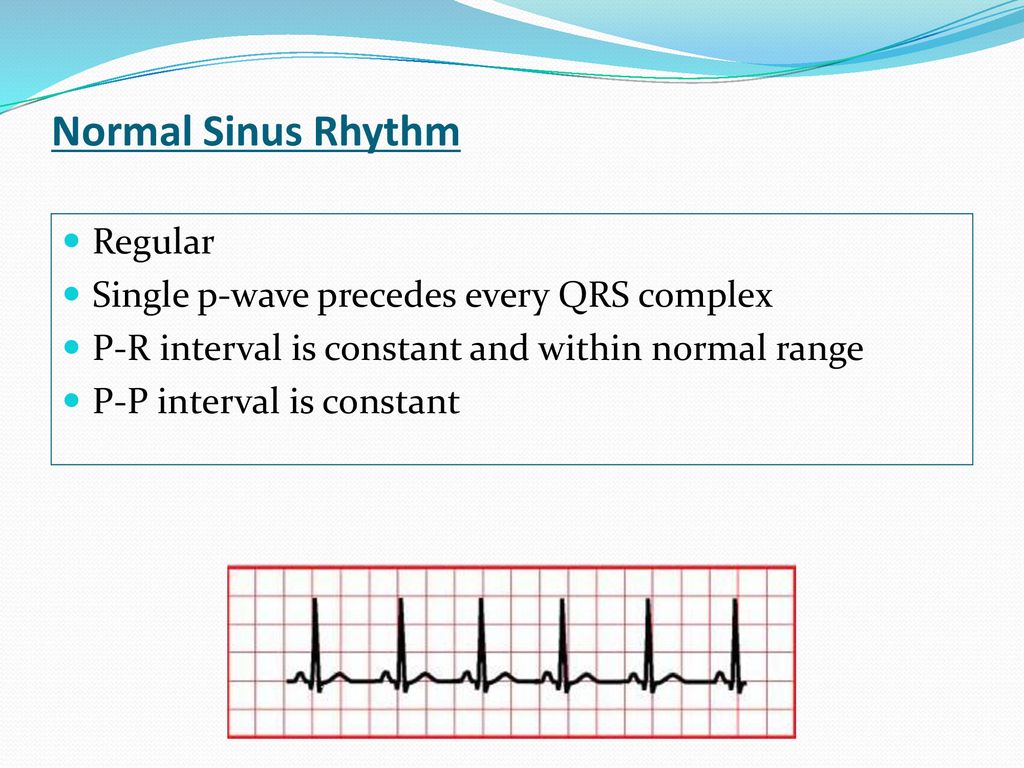 Cardiovascular System Block Cardiac Arrhythmias Physiology Ppt