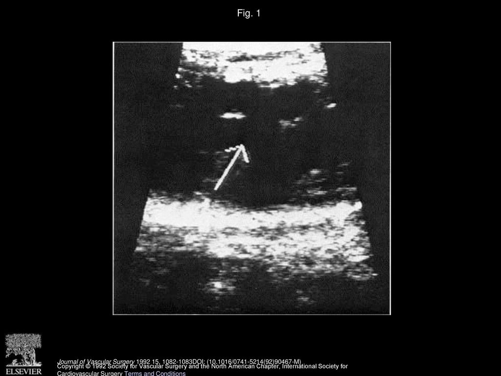 Fig. 1 Transverse duplex image at level of common femoral vein. Intraluminal echodense material was diagnostic for venous thrombosis.