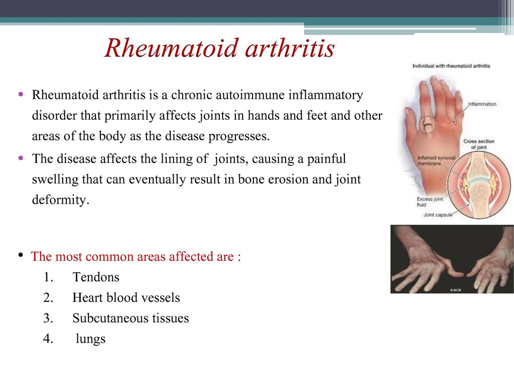 a rheumatoid arthritis közös leírása