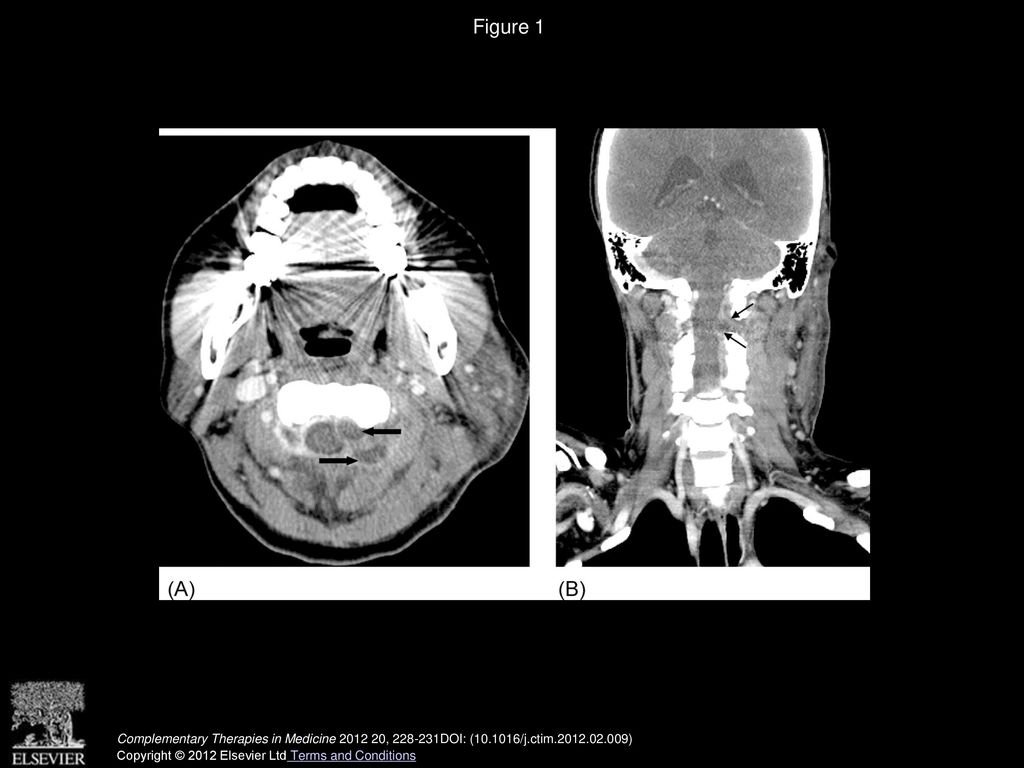 Figure 2 From Cervical Epidural Abscess After Cupping And Acupuncture