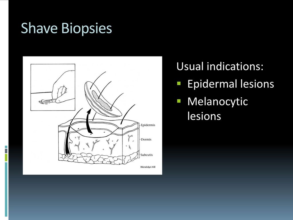 Grossing Skin Specimens - ppt download