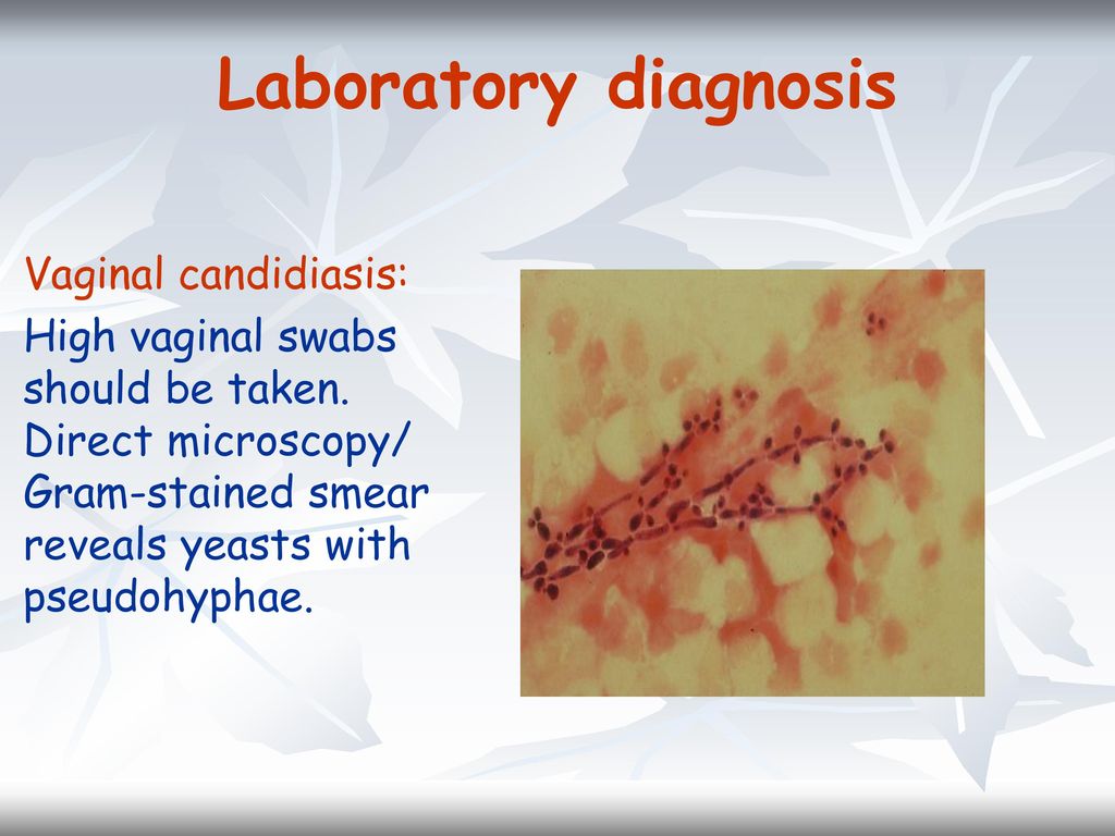Laboratory diagnosis Vaginal candidiasis: