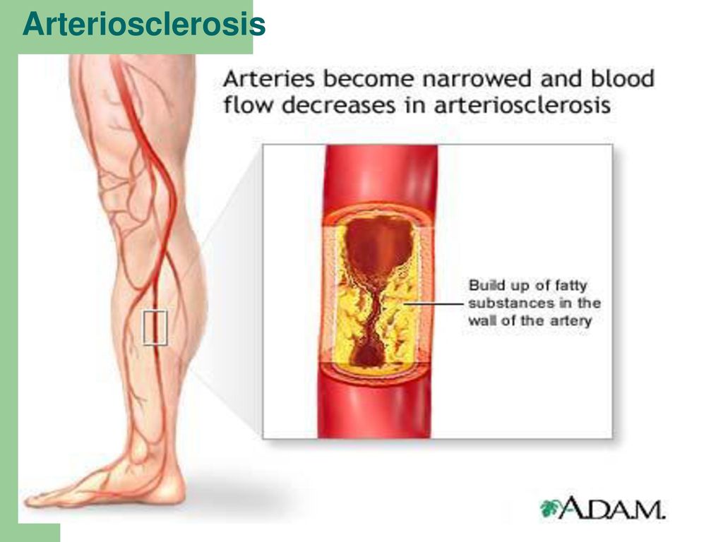 Облитерирующие заболевания сосудов. Облитерирующий атеросклероз сосудов нижних конечностей. Облитерирующий атеросклероз сосудов ног. Облитерирующий атеросклероз периферических артерий. Облитерирующий атеросклероз артерий ног.