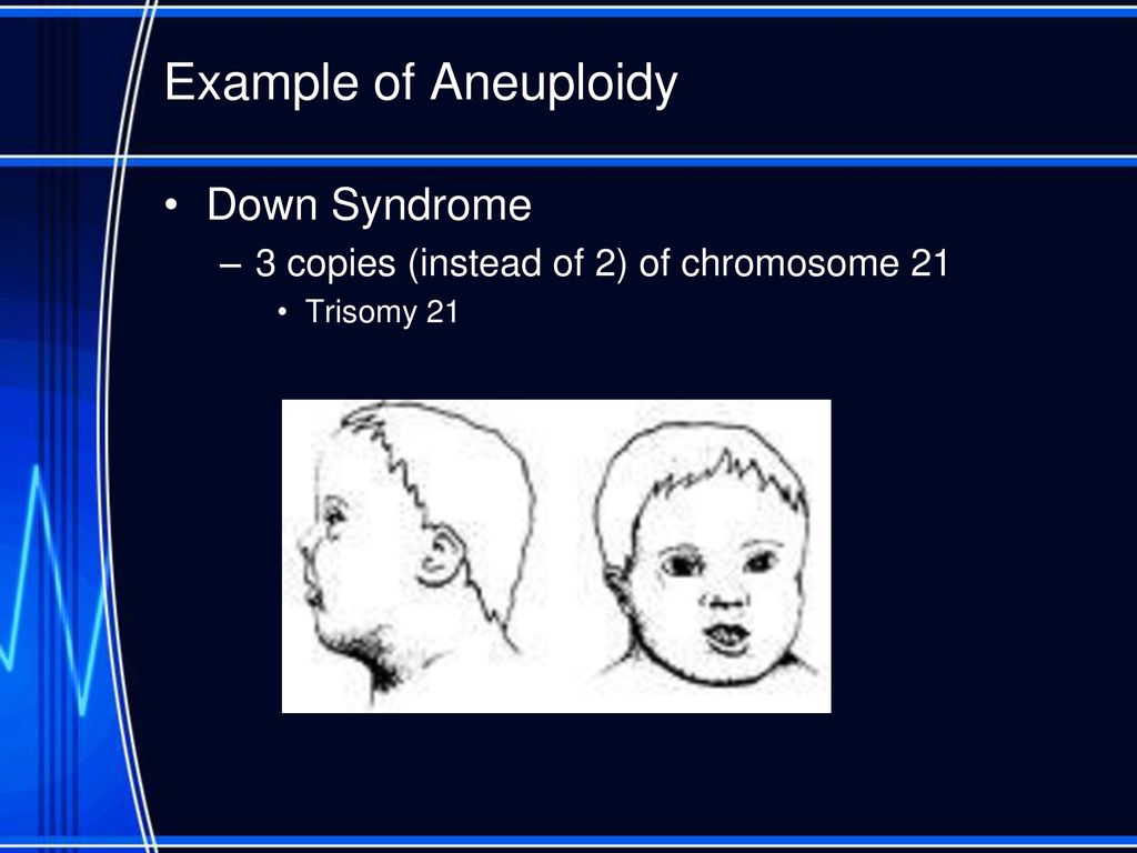 Example of Aneuploidy Down Syndrome