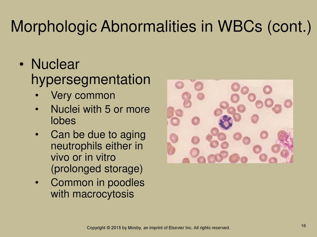 Morphologic Abnormalities in WBCs (cont.)