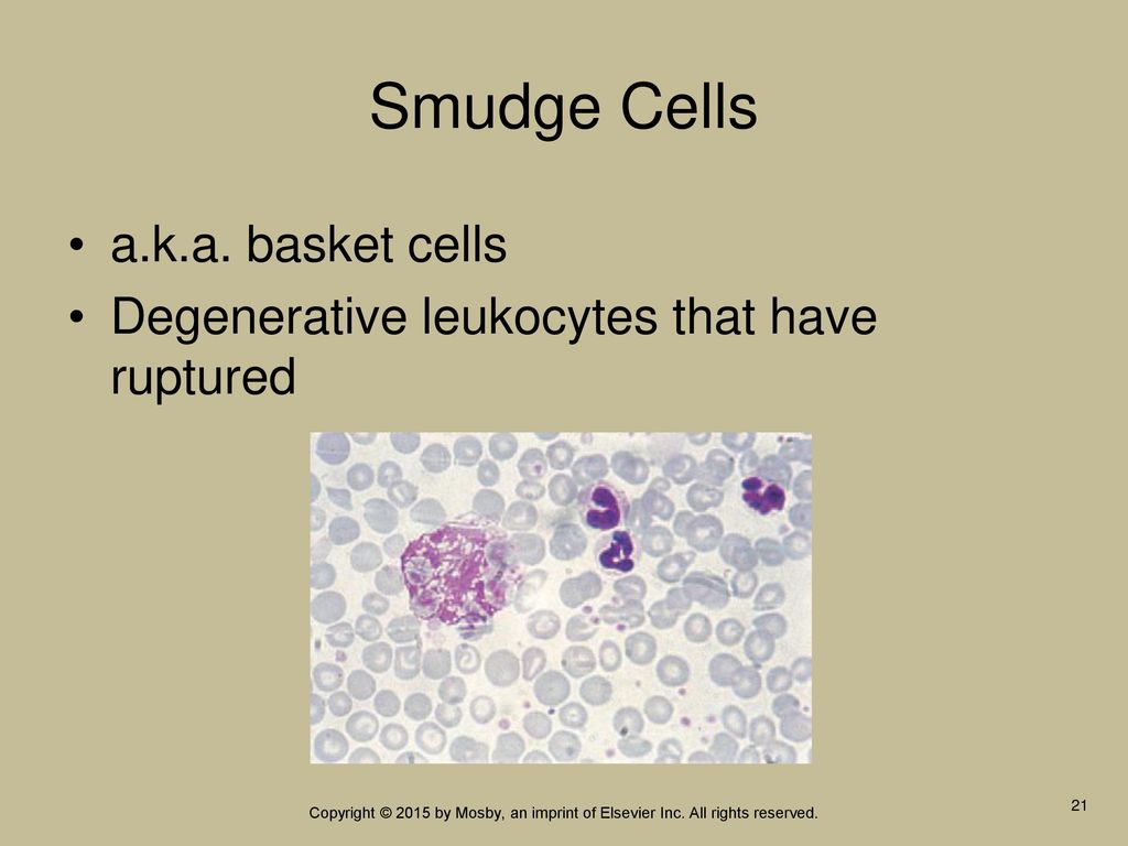 Smudge Cells a.k.a. basket cells