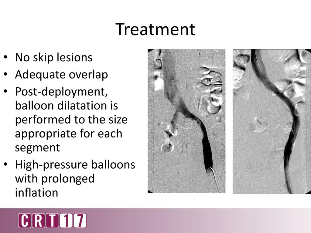 Recanilization Of Central Venous Total Occlusions Ppt Download recanilization-of-central-venous-total-occlusions-ppt-download