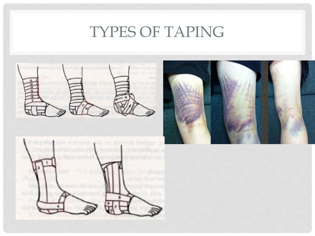 Ankle Taping for sprained ankle injury