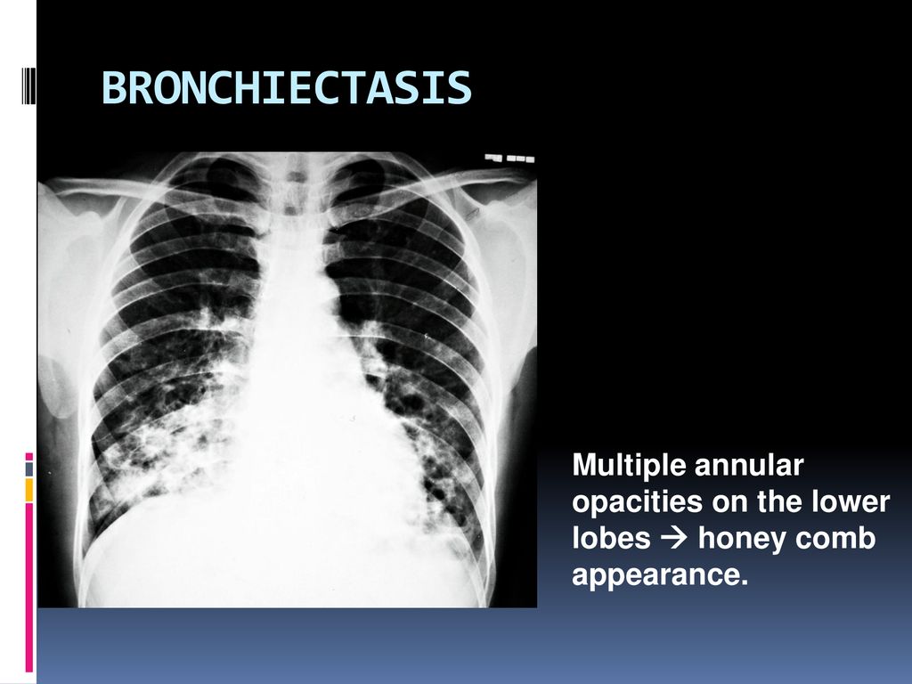 BRONCHIECTASIS Multiple annular opacities on the lower lobes  honey comb appearance.