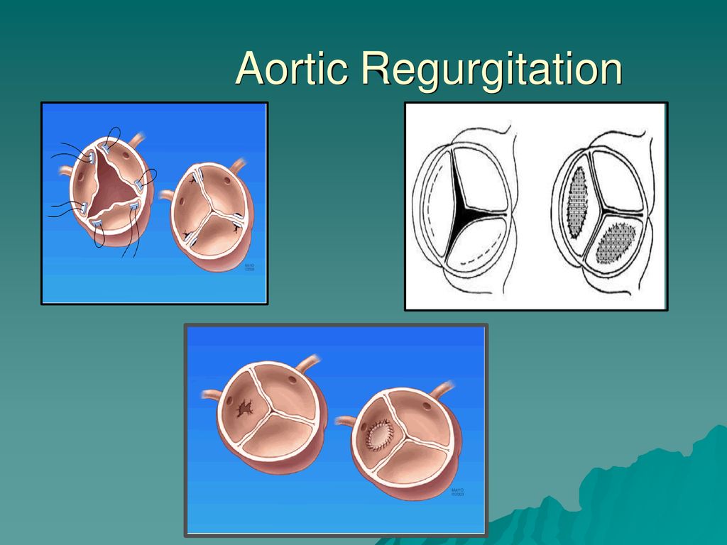 Aortic Regurgitation